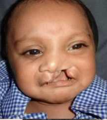 Before Cleft Lip Repair